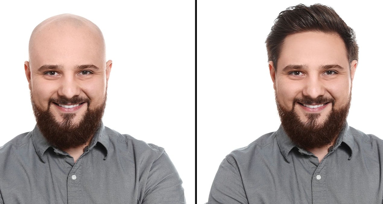 Kellik tedavisinde çığır açan çözüm: Saç büyümesini yüzde 539 artırıyor